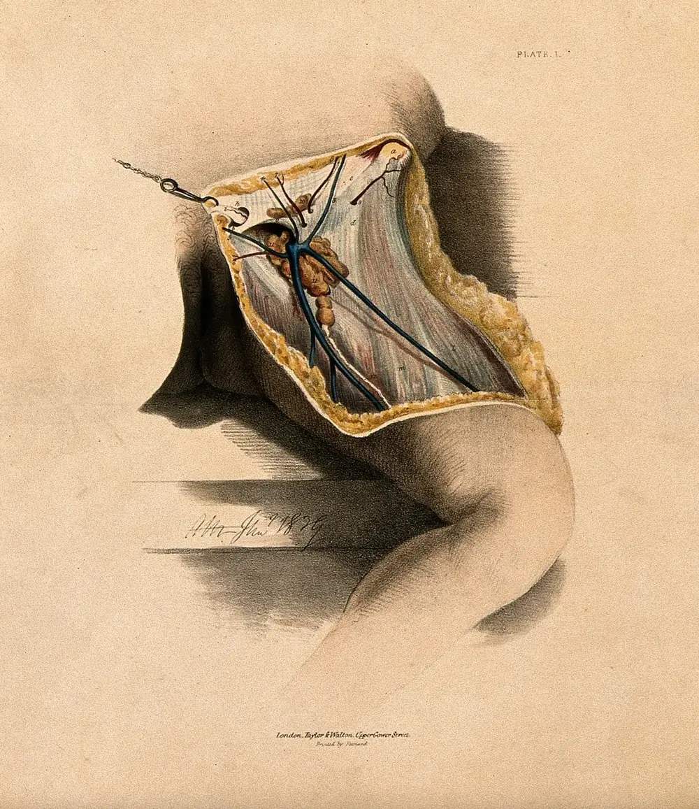 Nineteenth-century coloured lithograph of a dissection of the groin showing the fascia, blood vessels and lymphatic vessels